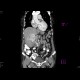 Renal cell carcinoma, recurrence, metastases: CT - Computed tomography